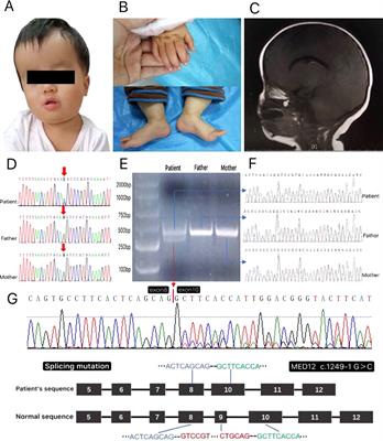 MED12-Related Disease in a Chinese Girl: Clinical Characteristics and Underlying Mechanism